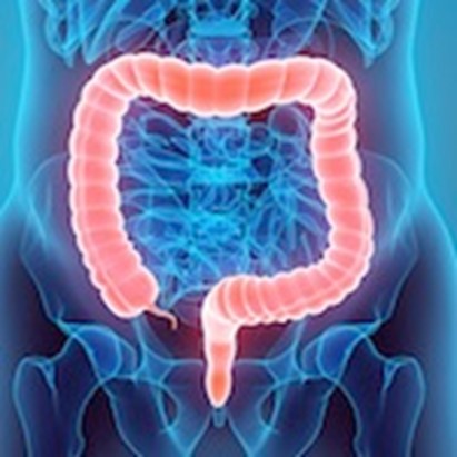 Tumore del colon retto: nelle donne sovrappeso rischio aumenta del 37% e in quelle obese del 93%