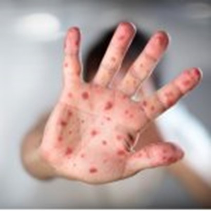 Morbillo. Unicef e Oms lanciano l’allarme: “Pandemia ha interrotto le campagne vaccinali. Nel mondo casi aumentati del 79%”