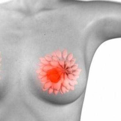 Tumore al seno. Un meccanismo lega gli adipociti alle metastasi