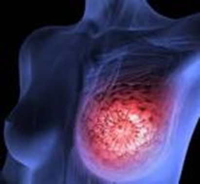 Tumore mammella HER2 positivo: promettenti i risultati del vaccino