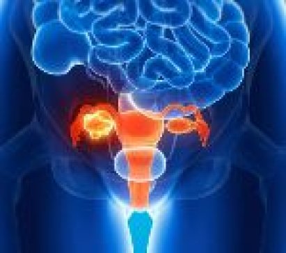 Losartan: un’arma contro il cancro dell’ovaio?