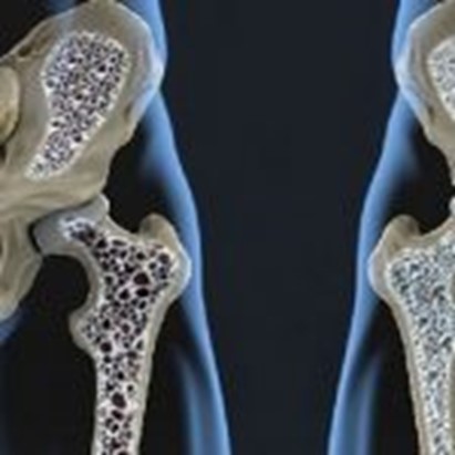 Osteoporosi. Attività cognitiva mentre si cammina riduce rischio cadute