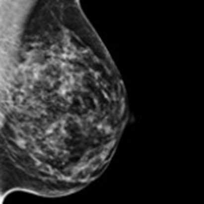 Tumore al seno. Per le donne anziane meglio la tomosintesi mammaria digitale
