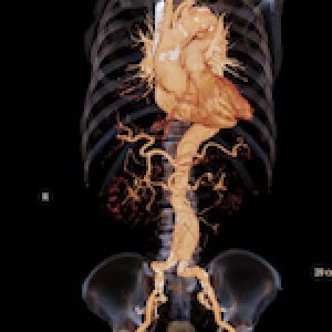 CT angiography of abdominal aorta 3D rendering image with x-ray image show aneurysm of abdominal aorta.