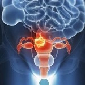 cancro-alla-cervice-uterina-500x307