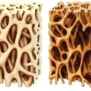 osteoporosi-aogoi