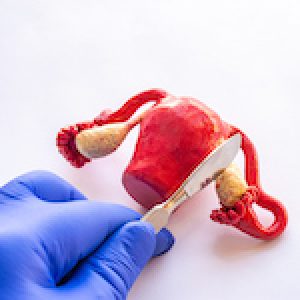 Concept of photo of ovariectomy or oophorectomy - total or part ovaries surgery or female operation. Doctor holds in his hand, dressed in surgical glove, scalpel over anatomical figure of ovaries